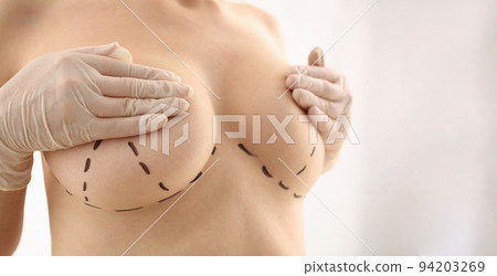 Woman with marks on chest for breast augmentation 94203269