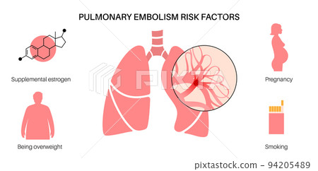 Pulmonary embolism disease Pulmonary embolism disease 94205489