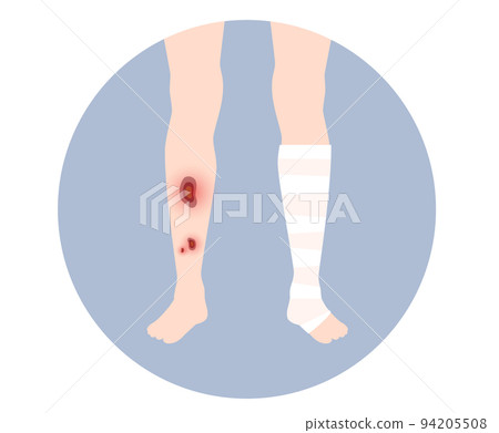 Human leg injury Human leg injury 94205508