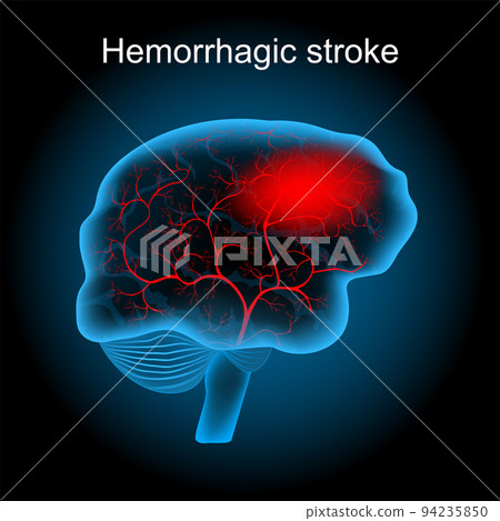 hemorrhagic stroke. human brain with blood vessels and hematoma hemorrhagic stroke. human brain with blood vessels and hematoma 94235850