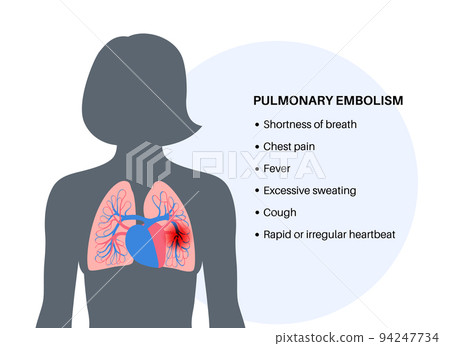 Pulmonary embolism disease Pulmonary embolism disease 94247734