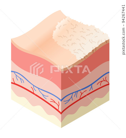 Skincare medical concept. Problems in cross-section of human skin horizontal layers structure. Anatomy illustrative model unhealthly layer of skin Skincare medical concept. Problems in cross-section of human skin horizontal layers structure. Anatomy illustrative model unhealthly layer of skin 94267441
