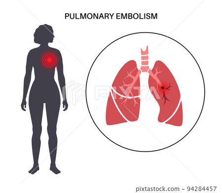 Pulmonary embolism disease 94284457