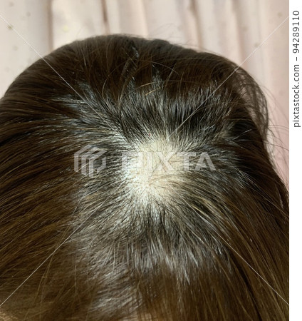 Alopecia areata Alopecia areata 94289110