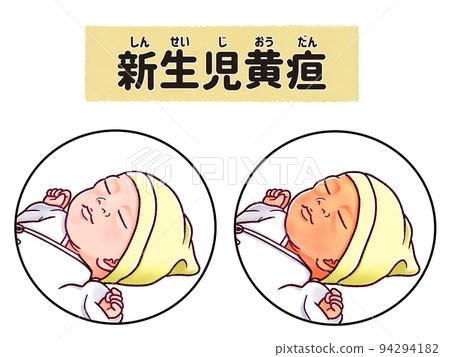 簡單易懂的日文插圖新生兒黃疸（病理性黃疸） 94294182