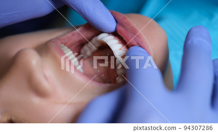 Doctor dentist examining patient oral cavity with veneers closeup 94307286