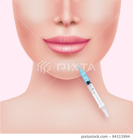 Lip enhancement filler in cosmetology. Hyaluronic acid gel. Botox injection lips. Medical and beauty concept. Lip enhancement filler in cosmetology. Hyaluronic acid gel. Botox injection lips. Medical and beauty concept. 94313994