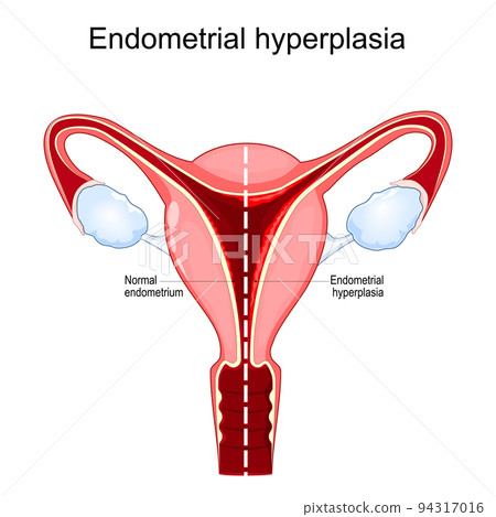 Endometrial hyperplasia 94317016