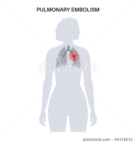 Pulmonary embolism disease Pulmonary embolism disease 94318632
