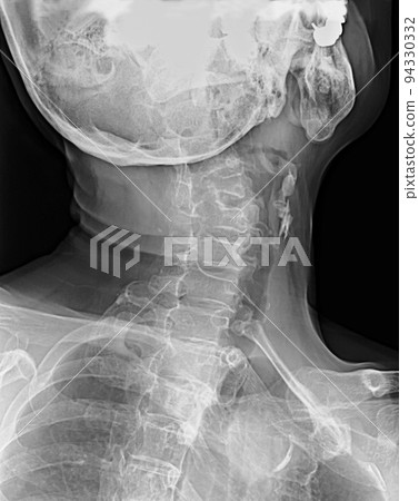 Radiograph Cervical X-ray X-ray 94330332