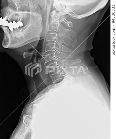 Radiograph Cervical X-ray X-ray 94330333