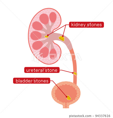Explanation illustration of kidney and bladder stones Explanation illustration of kidney and bladder stones 94337616