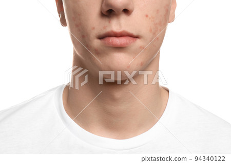 Teen guy with acne problem on white background, closeup 94340122