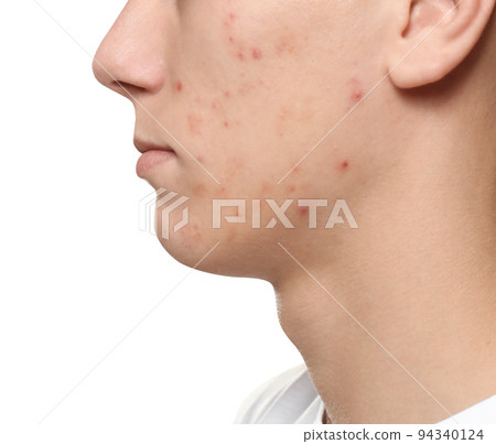 Teen guy with acne problem on white background, closeup 94340124