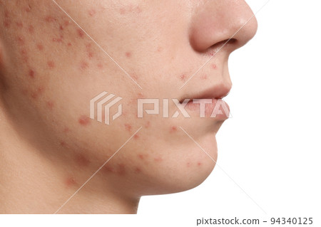 Teen guy with acne problem on white background, closeup 94340125