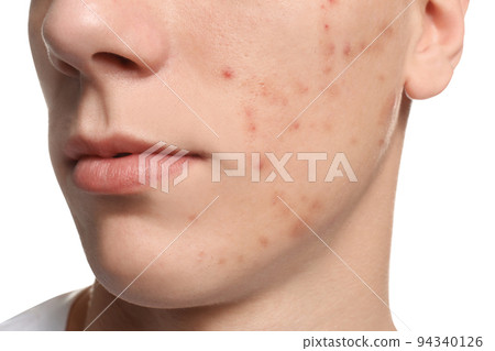 Teen guy with acne problem on white background, closeup 94340126