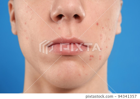 Teen guy with acne problem on blue background, closeup 94341357
