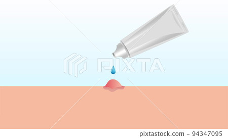 Applying gel, cream, ointment from tube on pimple. Skincare, breakout, problem skin, acne solution. Applying gel, cream, ointment from tube on pimple. Skincare, breakout, problem skin, acne solution. 94347095