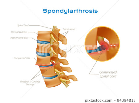 Spondylarthrosis Spinal Cord Infographics 94384815