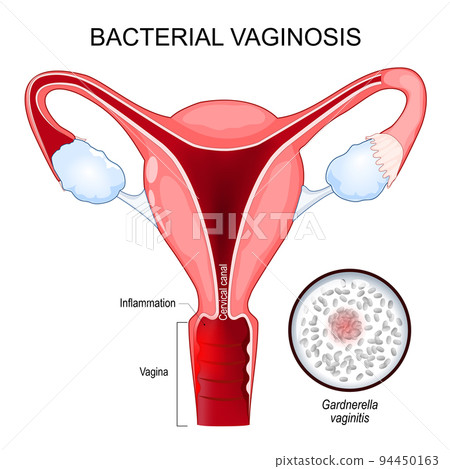 Bacterial vaginosis 94450163
