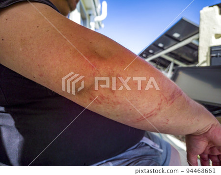 Scratchedd male arm after an accident 94468661