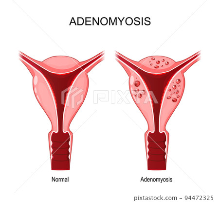 Adenomyosis. normal and unhealthy abnormal uterus. 94472325