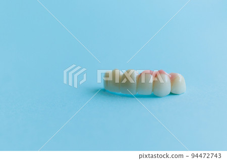 Artificial teeth on a blue background, dental crowns. Concept of dental implantation and restoration 94472743