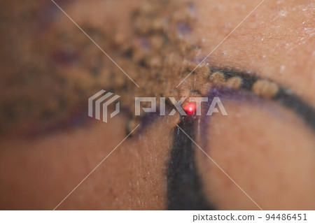 Young woman undergoing laser tattoo removal procedure in salon, closeup. 94486451