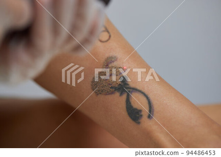 Young woman undergoing laser tattoo removal procedure in salon, closeup. 94486453