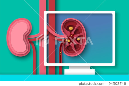 Kidney stones disease paper cut 3d vector Kidney stones disease paper cut 3d vector 94502746