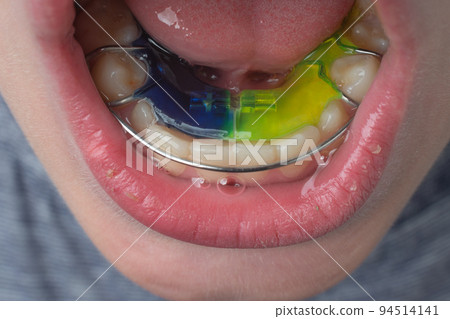Mandibular plate, a boy wears a plate to align his teeth. 94514141
