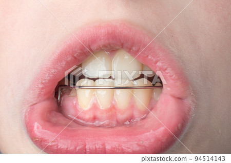 The boy wears a dental plate on his lower jaw. 94514143