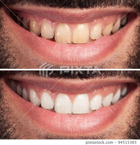 Closeup of man teeth before and after whitening or bleaching of smiling man. Dental health Concept. Oral Care concept 94515365