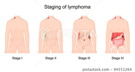lymphoma stage. Cancer of the lymphatic system. lymphoma stage. Cancer of the lymphatic system. 94551264