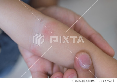 Woman hand holding infant leg. Red dry skin allergy from milk formula or other food. Closeup. 94557921
