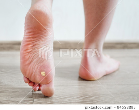 Close up photo of plantar wart on man's foot. Verruca plantaris on the heel. 94558893