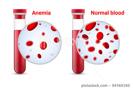 Anemia problem circulatory iron body diagram background. Anaemia biology blood isolated medical Anemia problem circulatory iron body diagram background. Anaemia biology blood isolated medical 94560160