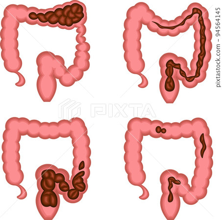 Functional constipation illustration 94564145