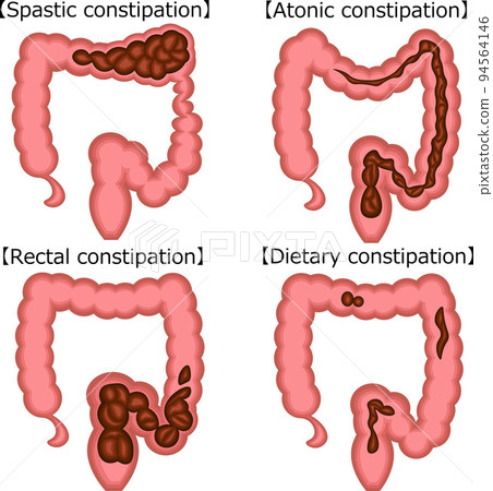 Functional constipation Illustration English 94564146