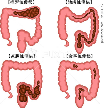 Functional constipation illustration Japanese 94564147