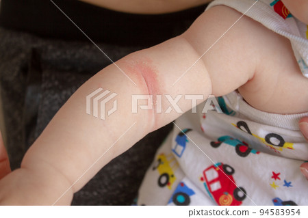 Prickly heat. Close-up of the folds of the hand of a newborn baby with red skin. Prickly heat. Close-up of the folds of the hand of a newborn baby with red skin. 94583954