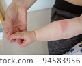 Prickly heat. Close-up of the folds of the hand of a newborn baby with red skin. 94583956