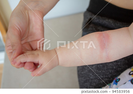 Prickly heat. Close-up of the folds of the hand of a newborn baby with red skin. Prickly heat. Close-up of the folds of the hand of a newborn baby with red skin. 94583956