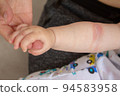 Prickly heat. Close-up of the folds of the hand of a newborn baby with red skin. 94583958