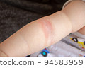 Prickly heat. Close-up of the folds of the hand of a newborn baby with red skin. 94583959