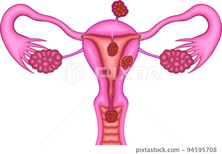 黏膜下肌瘤 漿膜下肌瘤 壁內肌瘤圖解 黏膜下肌瘤 漿膜下肌瘤 壁內肌瘤圖解 94595708