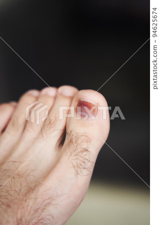 A toe is injured, a heavy object has fallen on the finger. Hematoma under the nail 94625674