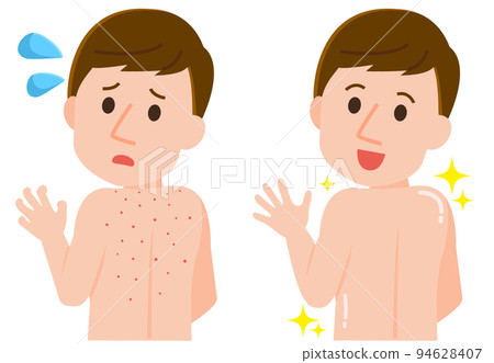 A man who suffers from back acne A man who heals beautifully illustration 94628407