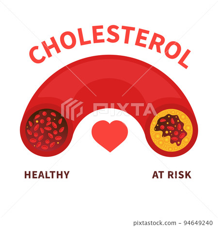 Cholesterol level meter gauge with blood vessel diagram 94649240
