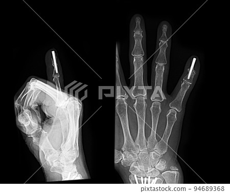 手部手指 X 線照片 Hebaden 結節治療 關節融合術 手部手指 X 線照片 Hebaden 結節治療 關節融合術 94689368